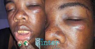 Agresiones en Bluefields refleja odio contra personas de la diversidad  sexual