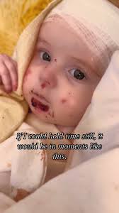 Understanding Epidermolysis Bullosa in Babies