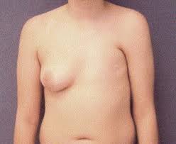 3, 4, 5 the absence of the sternal head of the pectoralis major muscle is considered the minimal expression of this syndrome. Poland S Syndrome And Premature Ovarian Failure Journal Of Pediatric And Adolescent Gynecology