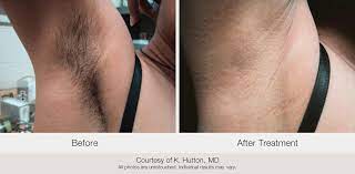 Laser hair removal is more than just ''zapping'' unwanted hair. Laser Hair Removal Elite Women S Healthcare