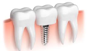 Diş köprüsünün avantaj ve dezavantajları nelerdir? Implant Fiyatlari 2021 Implant Dis Fiyati Hesaplama Akvadent