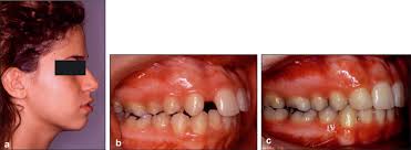a) Protrusion et incompétence labiales. (b) Avant traitement :...