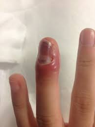 Image result for paronychium