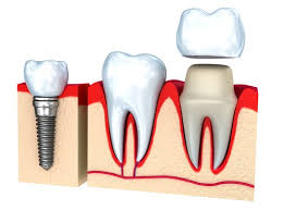 Check spelling or type a new query. How Much Does A Dental Crown Cost Platinum Dental Care