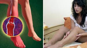 Thrombose Co Was Dahinter Steckt Wenn Ihre Beine Kribbeln Welt