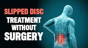 A 'slipped' (prolapsed) disc often causes sudden, severe lower back pain. Slipped Disc Treatment Without Surgery In Ayurveda Sureshot Ayurveda
