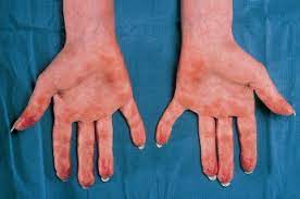 I was constantly rubbing my arms & legs to no relief. Systemic Lupus Erythematosus Medicine