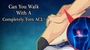 How to check if you tore your acl. Can You Walk With A Completely Torn Acl Acl Injury Recovery