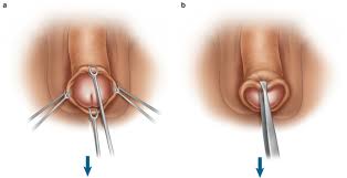 Image result for paraphimosis