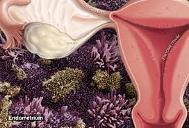 Theories on the pathogenesis of endometriosis. A Visual Guide To Endometriosis