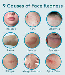 Image result for red rash face