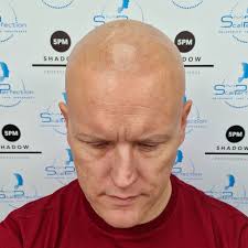 Scalp Micropigmentation St Neots