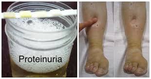 Dr norman pemakanan utk masalah buah pinggang. Menurut Doktor Ini Simpton Penyakit Yang Anda Hidapi Bila Kaki Bengkak Kencing Berbuih
