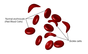 Approximately 100,000 americans have the disease. Sickle Cell Disease