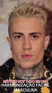 Transformação Facial: Antes e Depois da Harmonização do MC DANIEL