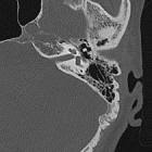 Image result for Ossicular Chain Disruption