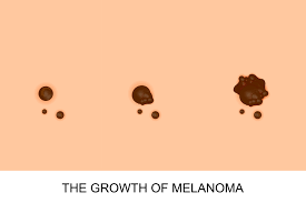 We may earn commission from links on this page, but we only recommend p. May Is Skin Cancer Awareness Month How To Prevent Spot And Treat