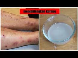 Bekas luka tersebut biasanya dianggap merusak penampilan anda, terutama di bagian terbuka seperti wajah, tangan, atau kaki. Pin Di Kream Wajah