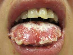 Stevens Johnson Syndrome Symptoms Causes And Treatment
