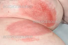 Image result for Intertrigo under breasts