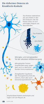 This is not just a disappointment to researchers and those in the medical field, but aducanumab was a sign of hope for all those families across the world who have a. Aducanumab Kommt Bald Ein Alzheimer Medikament Wissen Umwelt Dw 08 06 2021