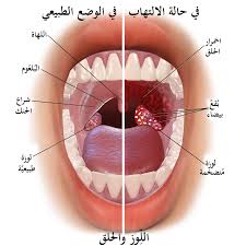 التهاب اللوزتين هو أحد أشهر الأمراض التي يمكن أن تصيب الأشخاص خاصة الصغار منهم، لذا ما هو علاج التهاب كما يعرف الأغلب، اللوزتين هما عبارة عن تجمع من النسيج الليمفاوي التي تشكّل جزء من الجهاز المناعي في الجسم تتواجدان في أقصى الحلق على الجهتين اليمنى. Ø§Ù„ØªÙ‡Ø§Ø¨ Ø§Ù„Ù„ÙˆØ²ØªÙŠÙ† ÙˆÙŠÙƒÙŠØ¨ÙŠØ¯ÙŠØ§
