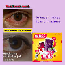 Jaundice itu sendiri merupakan simptom berbanding penyakit dan ia dikatergorikan dalam 3. Facebook