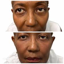 38 top Tear Trough Filler ideas in 2025