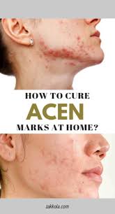 Home Remedies For Acne Scar Red Scar With Step By Step Picture Acneremedieshomemade Acneremediesovern Home Remedies For Acne Acne Remedies Acne Scar Remedies