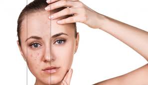 Jerawat, blackhead dan cela lain mudah nak singgah. Kenali 5 Jenis Kulit Wajah Anda Termasuk Yang Mana Gaya Tempo Co