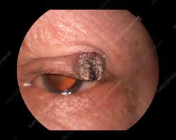 Image result for cornu cutaneum)