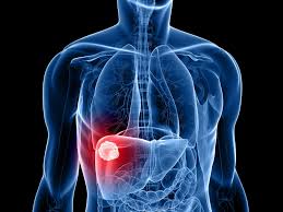 Signs and symptoms of liver cancer some early cancers may have signs and symptoms that can be noticed, but that is not always. Liver Cancer Symptoms Causes Treatment Narayana Health