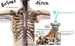 Reckless Rants And Raves I Had Tos Surgery Rib Resection Surgery
