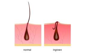 Overview an ingrown hair occurs when a shaved or tweezed hair grows back into the skin. Ingrown Hair Symptoms Treatment Prevention Skinkraft