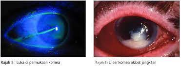 Sebelumnya, yang kita ketahui, seoarang teknisi sering. Ulser Kornea Apakah Puncanya Mata By Optometrist