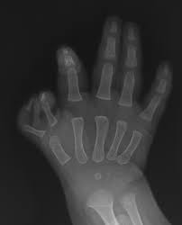 Image result for Supernumerary Digit