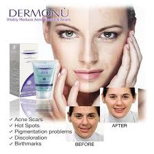 Blackhead remover cream in pakistan. Dermonu Cream Pakistan Acne Removal Cream In Pakistan