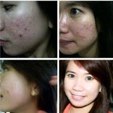 Lemon adalah salah satu agen pemutih alami, kandungan vitamin c pada lemon. Cara Ampuh Menghilangkan Bopeng Atau Lubang Bekas Jerawat Cara Ampuh Menghilangkan Bopeng Atau Lubang Bekas Jerawat