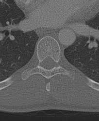 Radiology Quiz 40181 Radiopaedia Orgviewing Playlist Normal Spine Exams Review For App Radiopaedia Org Klicken sie hier um mehr informationen zu dieser webseite zu erhalten. radiopaedia