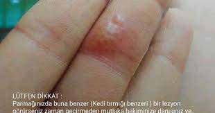 lesyon onkoloji akciger kanser losemi lesyon onkoloji akciger kanser losemi akciger kanser lesyon los akciger kanseri serum isaretler