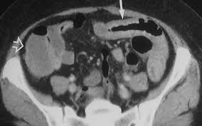 Image result for Neutropenic Colitis