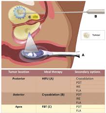 Prostate cancer is a common type of cancer in men, according to the mayo clinic. Which Technology To Select For Primary Focal Treatment Of Prostate Cancer European Section Of Urotechnology Esut Position Statement Prostate Cancer And Prostatic Diseases