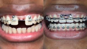 Once your braces are removed, it is important that you keep the gaps closed by regular brushing and flossing. Braces Update My Gap Is Closed Starring Shameka Youtube