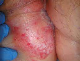 Extramammary Paget Disease Of Skin Dermnet Nz