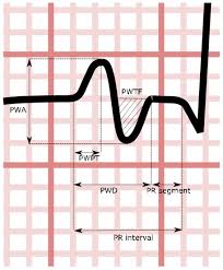 Image result for PR Interval