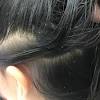Lice Eggs In Hair Vs Dandruff