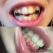 Nov 06, 2020 · the exact length depends on your orthodontist or dentist's recommendation. May 2018 July 2019 Only Wearing My Night Time Retainers Now Invisalign