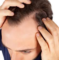 Hairloss treatment malaysia ( solution and scientifically proven ). Men S Hair Loss What You Need To Know