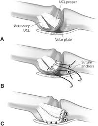 Gamekeeper's thumb (or skier's thumb) derives its name from court gamekeepers who developed chronic degeneration of the ulnar collateral ligament (ucl) of the m. References In Return To Football And Long Term Clinical Outcomes After Thumb Ulnar Collateral Ligament Suture Anchor Repair In Collegiate Athletes Journal Of Hand Surgery