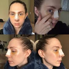 Nose Job Surgery Recovery Cast Removal Two Week Post Op Reveal Until The Very Trend Nose Job Rhinoplasty Recovery Nose Jobs Nose Job Recovery